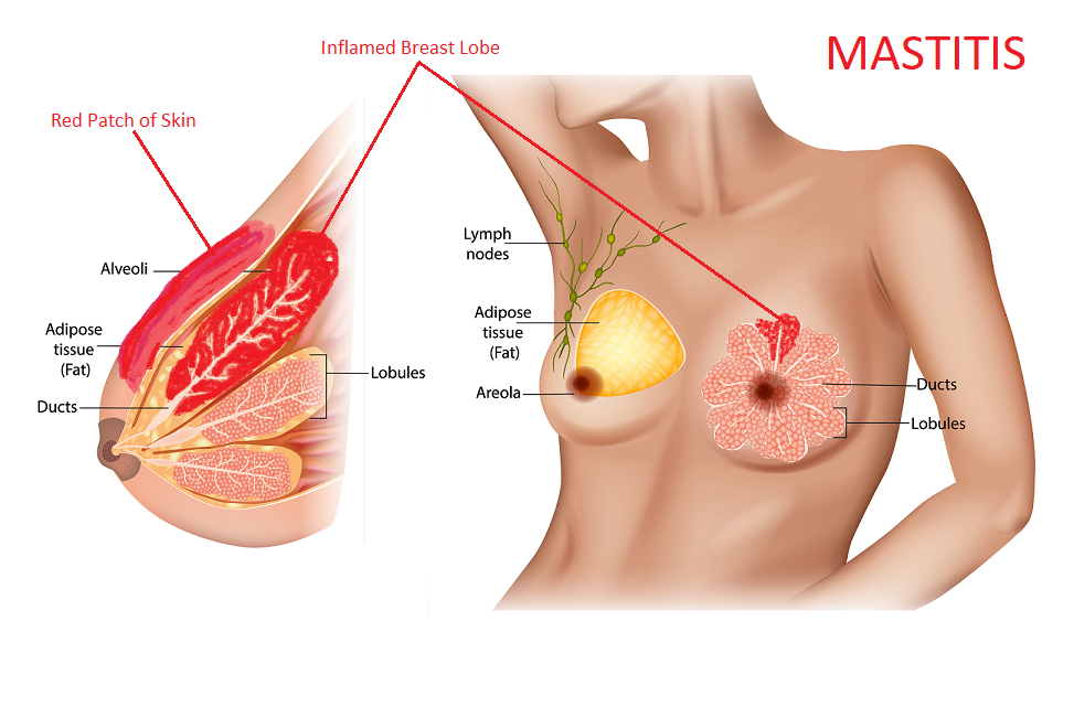 mastitis symptoms | mastitis