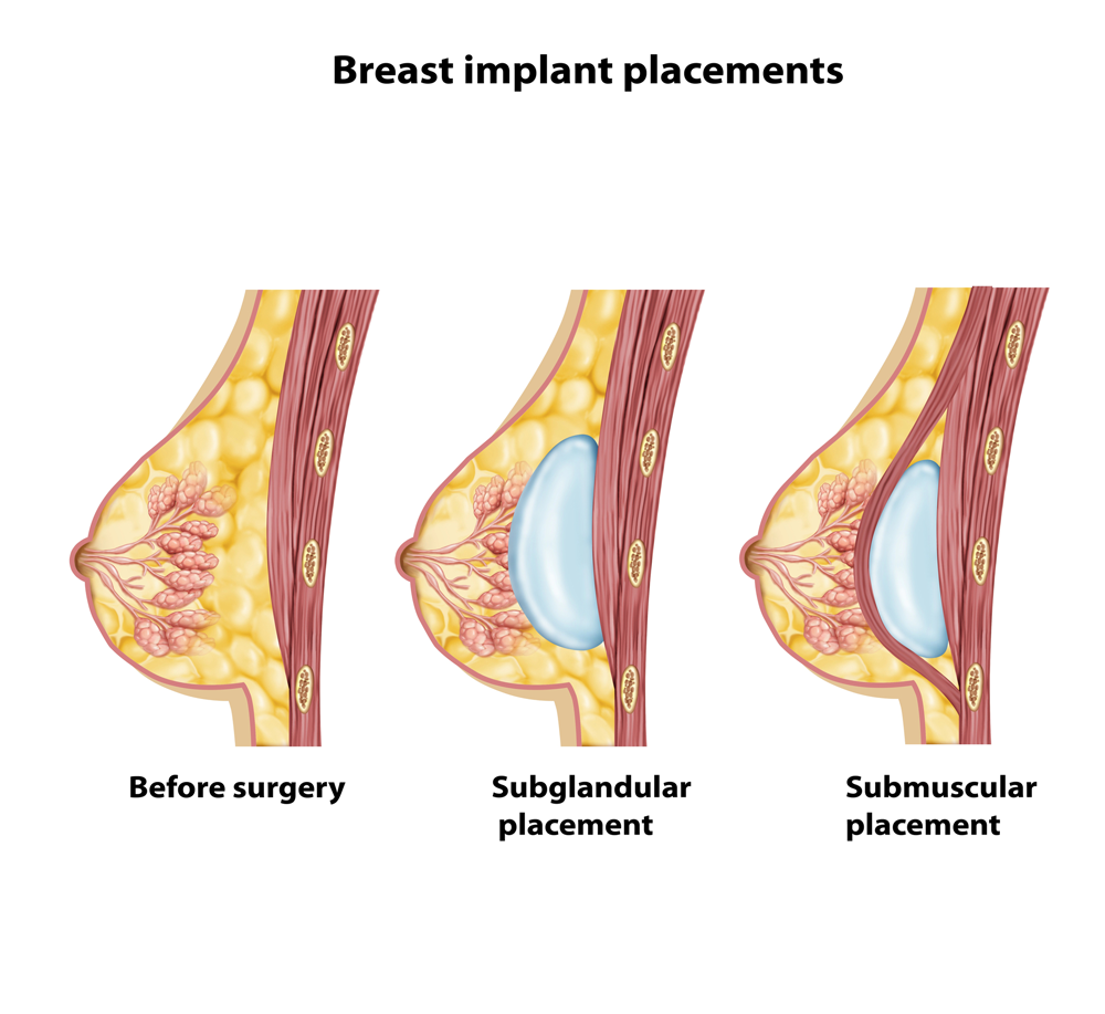 breast implant placement