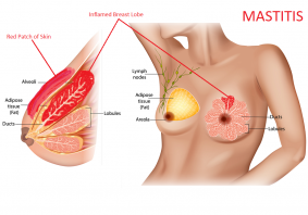 mastitis symptoms | mastitis