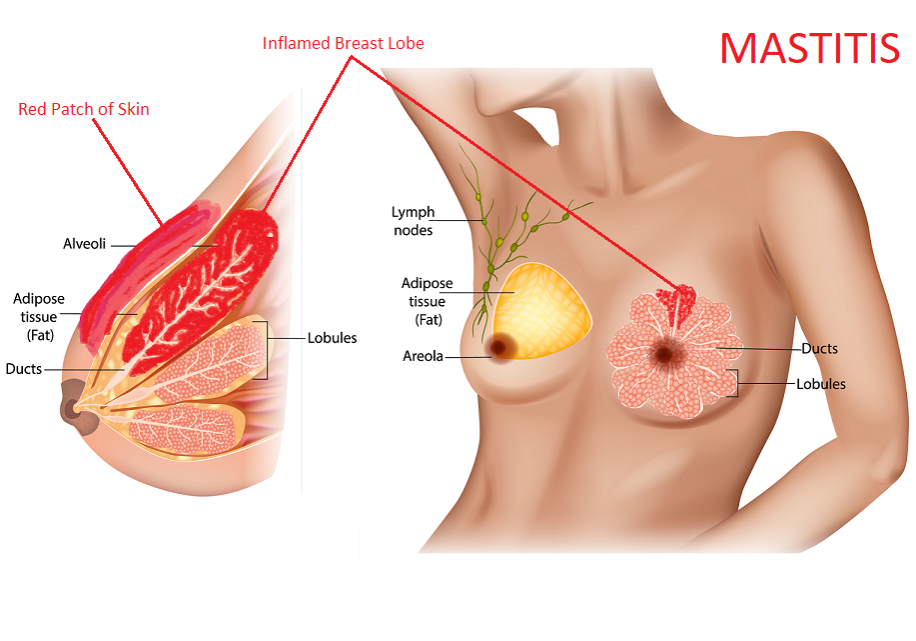 mastitis in women symptoms